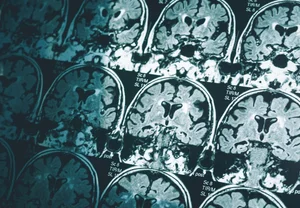 Мозги мужчин скукоживаются быстрее: почему у женщин все равно чаще Альцгеймер?