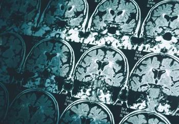 Мозги мужчин скукоживаются быстрее: почему у женщин все равно чаще Альцгеймер?