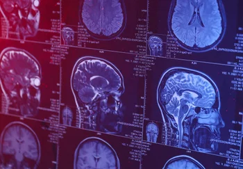 Деменция: когда старость приходит к 24 годам – и чему нас учит последний подарок Андре Ярхема