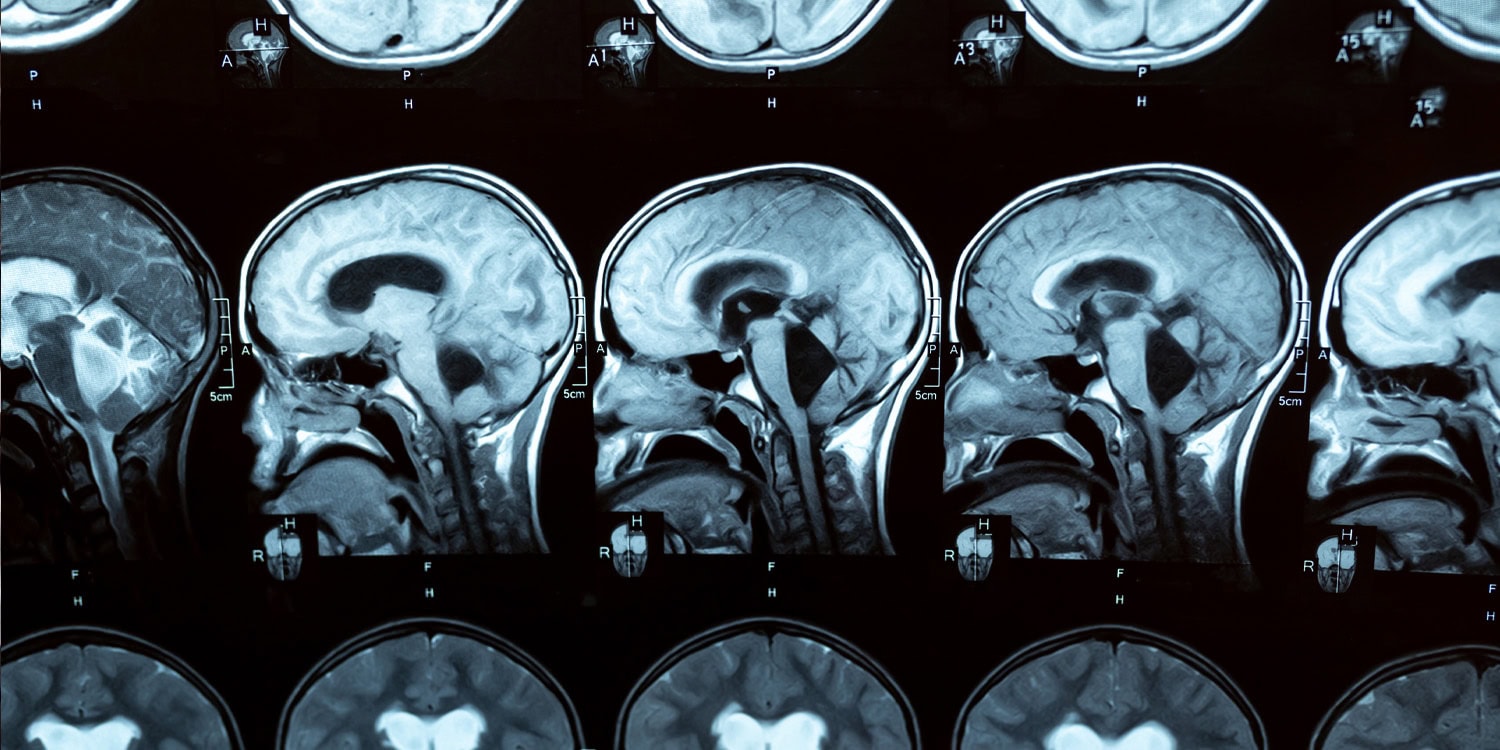 Когда мозг начинает «ругаться» сам с собой: как два заклятых соседа предсказывают приход Альцгеймера