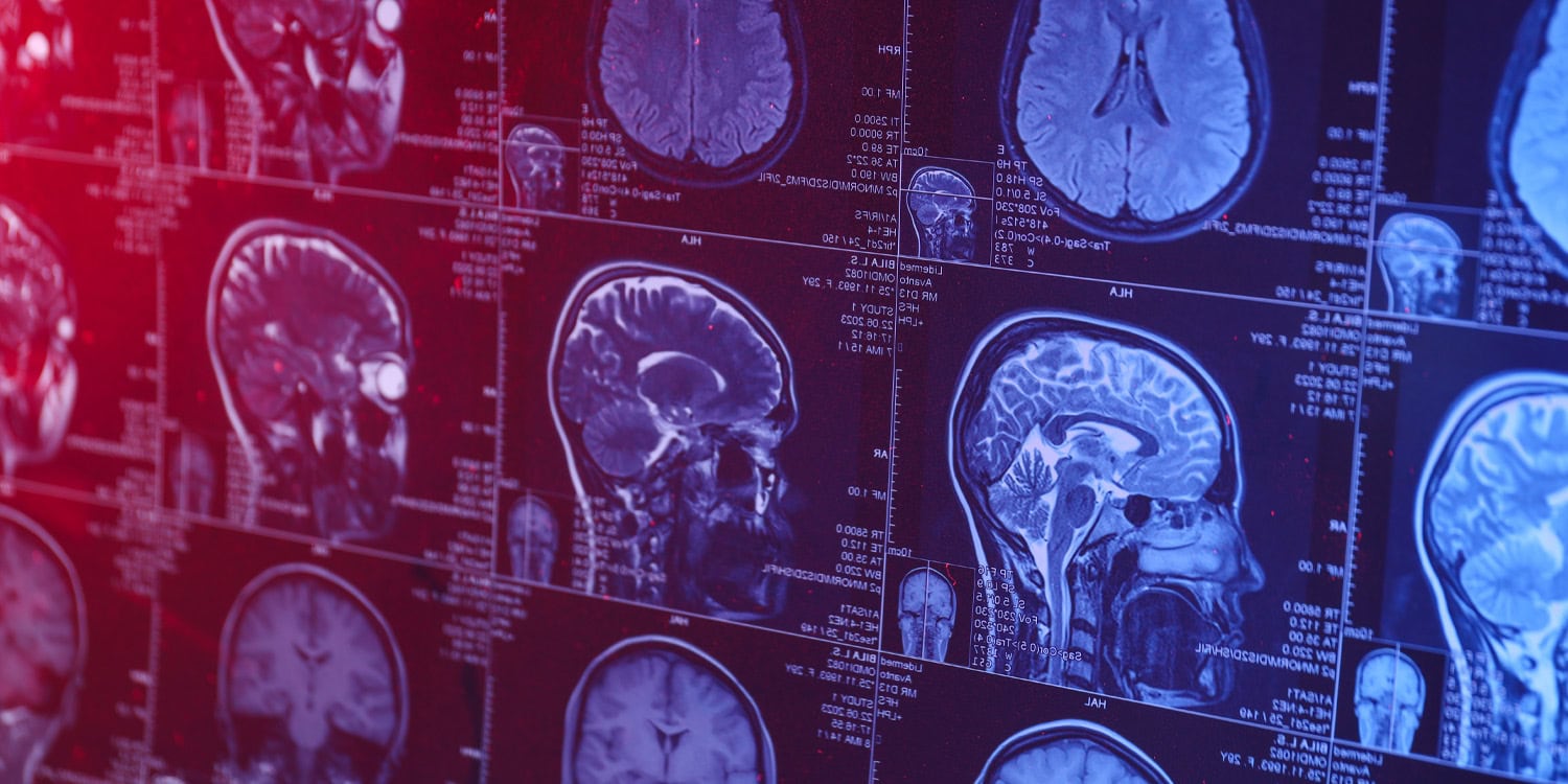 Деменция: когда старость приходит к 24 годам – и чему нас учит последний подарок Андре Ярхема